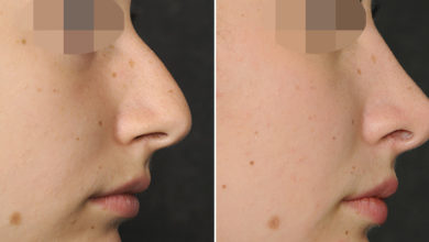 جراحی زیبایی بینی