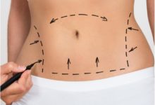 تزریق چربی به بدن-سایت خبری ازدیدما