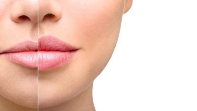 تزریق ژل لب-سایت خبری ازدیدما