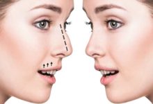 جراحی بینی-سایت خبری ازدیدما