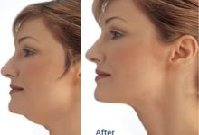 ساکشن غبغب-سایت خبری ازدیدما