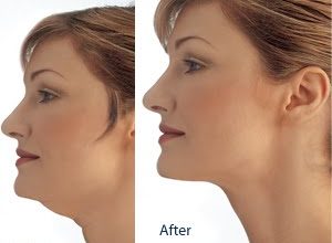 ساکشن غبغب-سایت خبری ازدیدما