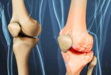 آرتروز چیست -سایت خبری ازدیدما