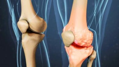 آرتروز چیست -سایت خبری ازدیدما