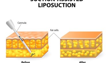 لیپوساکشن -سایت خبری ازدیدما