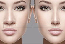 تفاوت بینی گوشتی و استخوانی