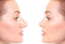 تفاوت جراحی بینی استخوانی و گوشتی -سایت خبری ازدیدما