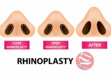 تفاوت جراحی بینی به روش باز و بسته -سایت خبری ازدیدما