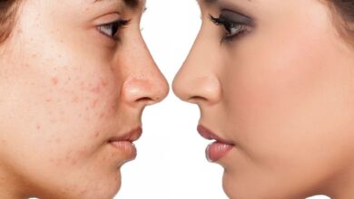 جوش پوست- سایت ازدیدما