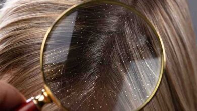 علت شوره سر و درمان آن - سایت خبری ازدیدما