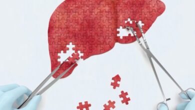 درمان کبد چرب با طب سنتی - سایت خبری ازدیدما